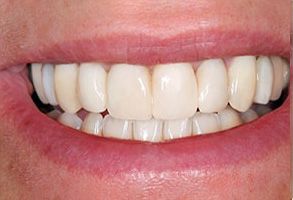 Northshore Family Dentistry | Ceramic Crowns, Veneers and Dental Fillings